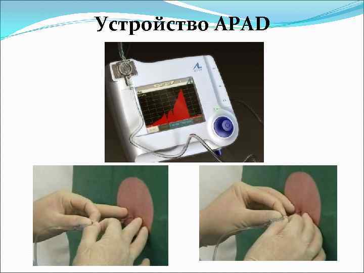 Устройство APAD 