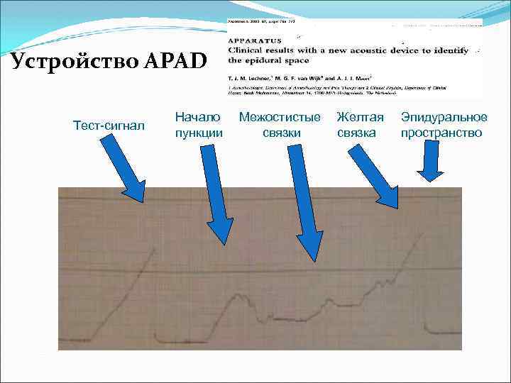 Устройство APAD Тест-сигнал Начало пункции Межостистые связки Желтая связка Эпидуральное пространство 