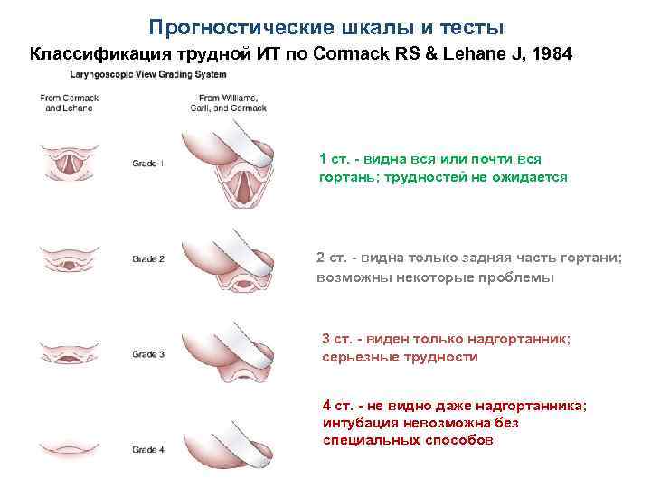 Прогностические шкалы и тесты Классификация трудной ИТ по Cormack RS & Lehane J, 1984