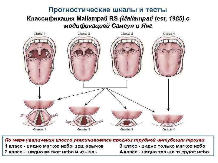 Прогностические шкалы и тесты Классификация Mallampati RS (Mallampati test, 1985) с модификацией Самсун и