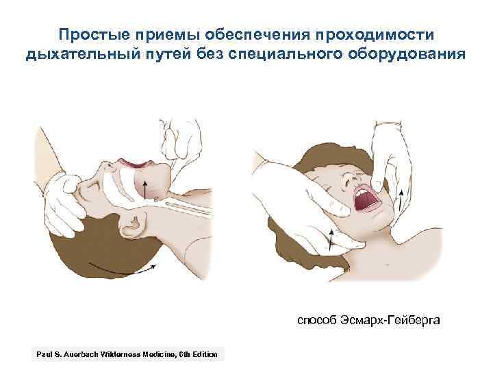 Простые приемы обеспечения проходимости дыхательный путей без специального оборудования способ Эсмарх Гейберга Paul S.