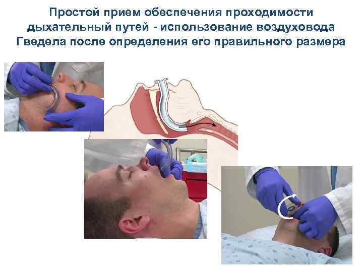 Простой прием обеспечения проходимости дыхательный путей - использование воздуховода Гведела после определения его правильного