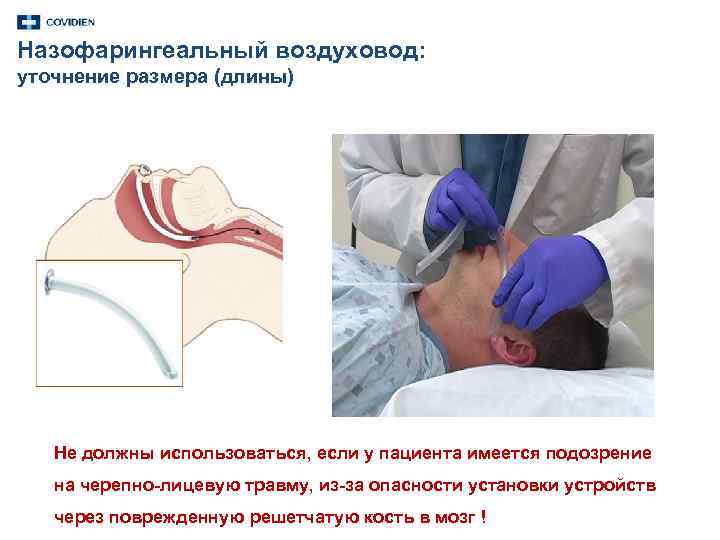 Назофарингеальный воздуховод: уточнение размера (длины) Не должны использоваться, если у пациента имеется подозрение на