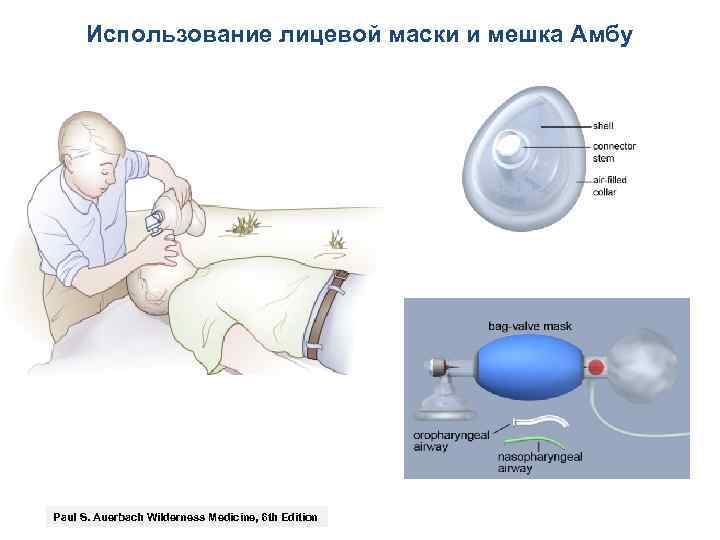 Мешок амбу рисунок