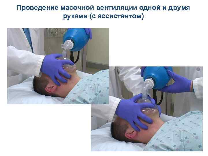 Проведение масочной вентиляции одной и двумя руками (с ассистентом) 