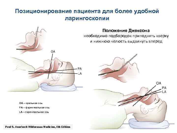 Позиционирование пациента для более удобной ларингоскопии Положение Джексона необходимо подбородок приподнять кверху и нижнюю