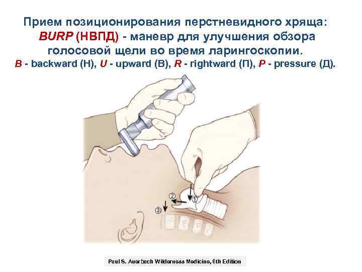 Прием позиционирования перстневидного хряща: BURP (НВПД) - маневр для улучшения обзора голосовой щели во