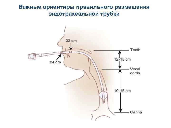 Важные ориентиры правильного размещения эндотрахеальной трубки 