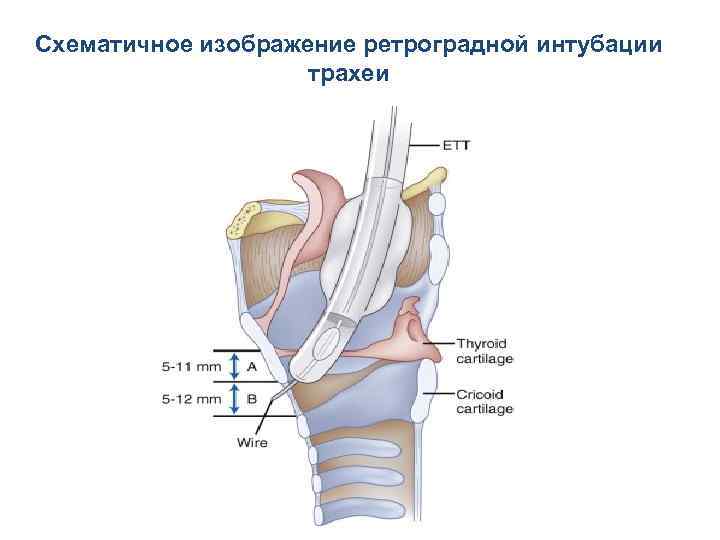 Схематичное изображение ретроградной интубации трахеи 
