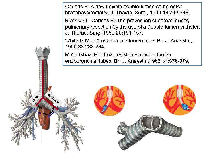 Carlens E: A new flexible double lumen catheter for bronchospirometry. J. Thorac. Surg. ,