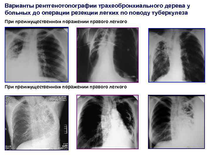 Варианты рентгенотопографии трахеобронхиального дерева у больных до операции резекции легких по поводу туберкулеза При