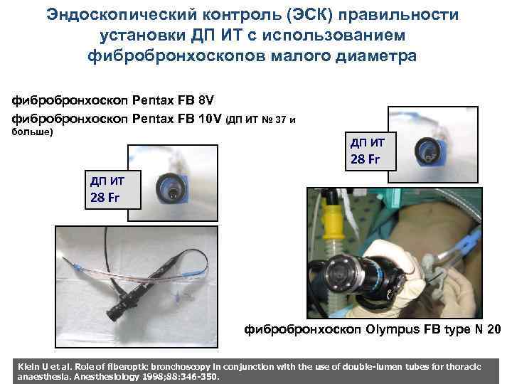 Эндоскопический контроль (ЭСК) правильности установки ДП ИТ с использованием фибробронхоскопов малого диаметра фибробронхоскоп Pentax