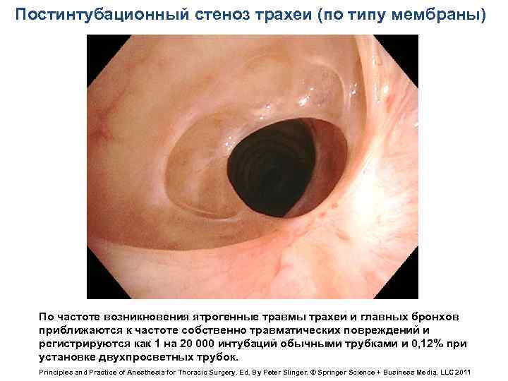 Постинтубационный стеноз трахеи (по типу мембраны) По частоте возникновения ятрогенные травмы трахеи и главных