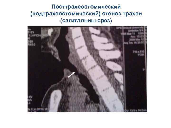 Посттрахеостомический (подтрахеостомический) стеноз трахеи (сагитальны срез) 