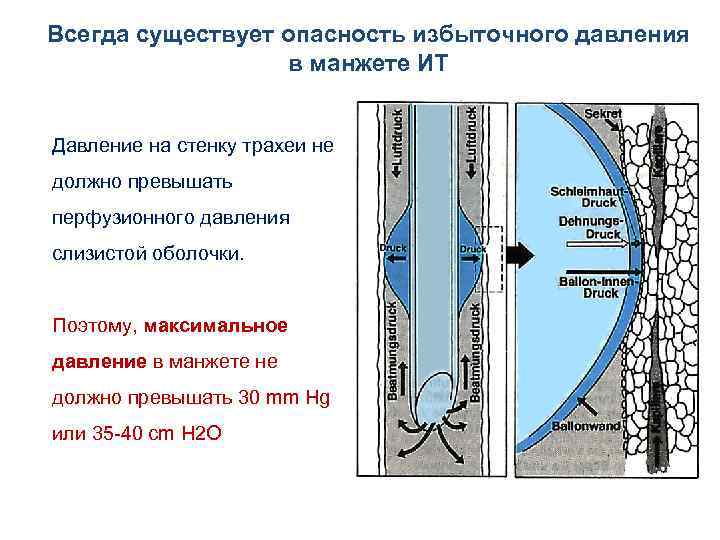 Всегда существует опасность избыточного давления в манжете ИТ Давление на стенку трахеи не должно