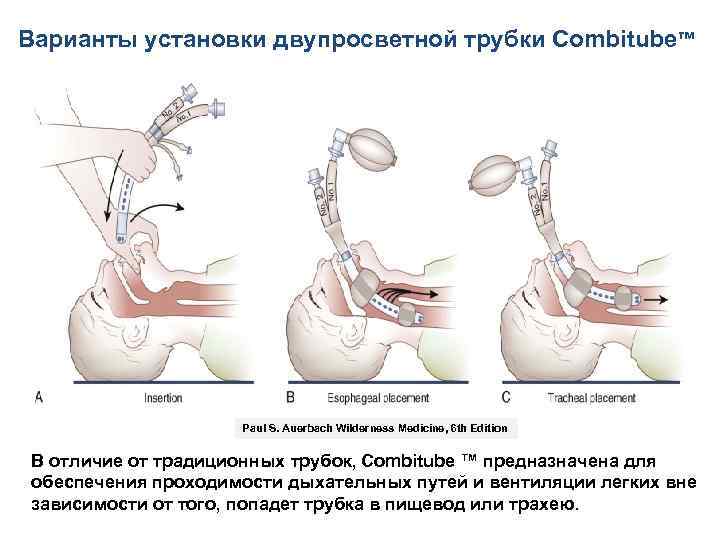 Варианты установки двупросветной трубки Combitube™ Paul S. Auerbach Wilderness Medicine, 6 th Edition В