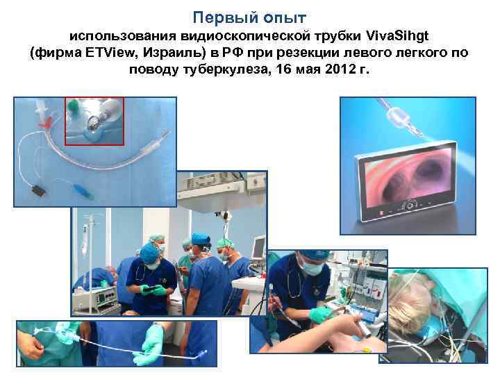 Первый опыт использования видиоскопической трубки Viva. Sihgt (фирма ETView, Израиль) в РФ при резекции