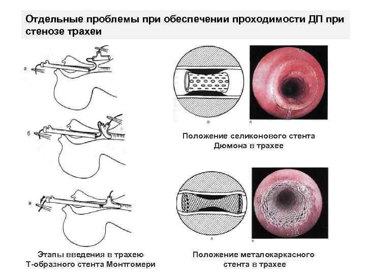Отдельные проблемы при обеспечении проходимости ДП при стенозе трахеи Положение селиконового стента Дюмона в