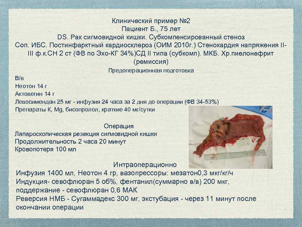 Клинический пример № 2 Пациент Б. , 75 лет DS. Рак сигмовидной кишки. Субкомпенсированный