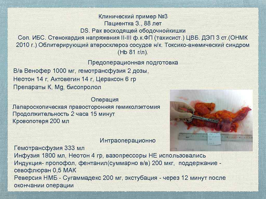Клинический пример № 3 Пациентка З. , 88 лет DS. Рак восходящей ободочнойкишки Соп.
