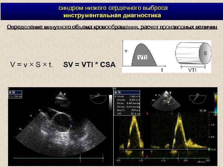 синдром низкого сердечного выброса инструментальная диагностика Определение минутного объема кровообращения, расчет производных величин
