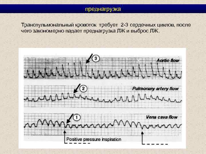 преднагрузка Транспульмональный кровоток требует 2 -3 сердечных циклов, после чего закономерно падает преднагрузка ЛЖ