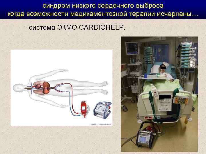синдром низкого сердечного выброса когда возможности медикаментозной терапии исчерпаны… система ЭКМО CARDIOHELP. 