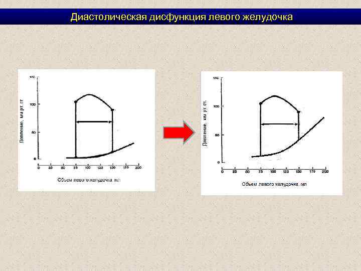 Дисфункция миокарда левого желудочка 1 тип. Диастолическая дисфункция левого желудочка. Кривая давление объем для левого желудочка. Диаграмма давление объем для левого желудочка. Типы диастолической дисфункции левого желудочка.