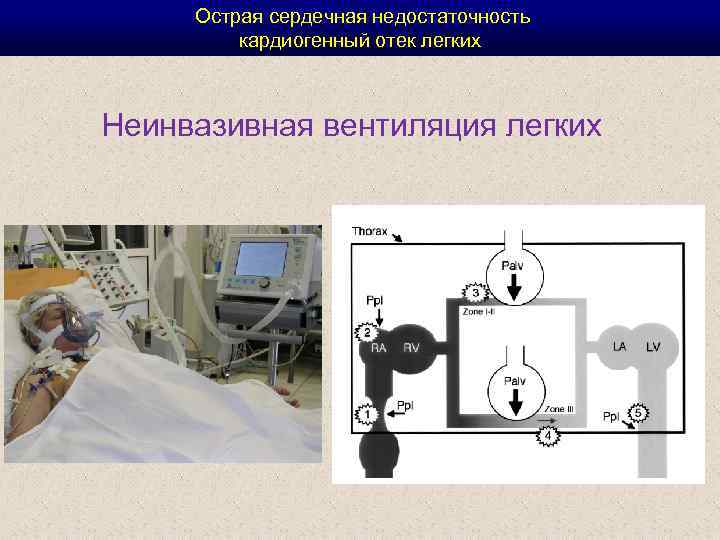  Острая сердечная недостаточность кардиогенный отек легких Неинвазивная вентиляция легких 