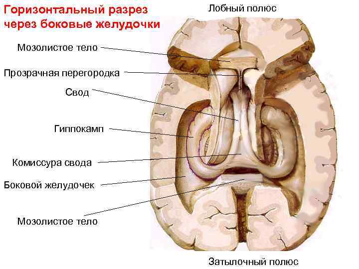 Горизонтальный разрез через боковые желудочки Лобный полюс Мозолистое тело Прозрачная перегородка Свод Гиппокамп Комиссура