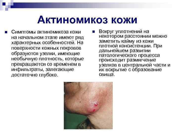 Актиномикоз кожи n Симптомы актиномикоза кожи на начальном этапе имеют ряд характерных особенностей. На