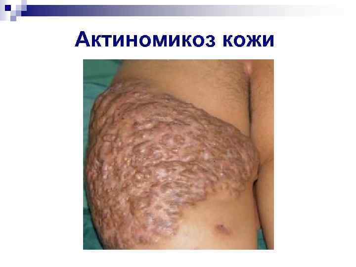 Актиномикоз кожи 