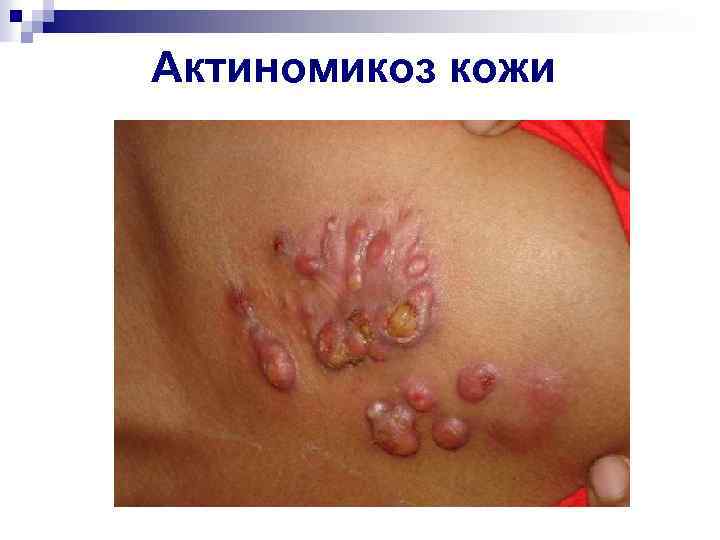 Актиномикоз кожи 