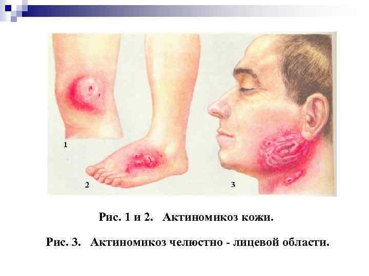 Рис. 1 и 2. Актиномикоз кожи. Рис. 3. Актиномикоз челюстно - лицевой области. 