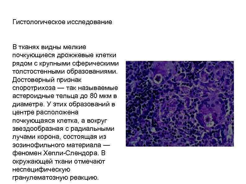 Гистология анализ. Гистологический признак саркоидоза. Болезни гистологическое исследование. Споротрихоз астероидные тельца.