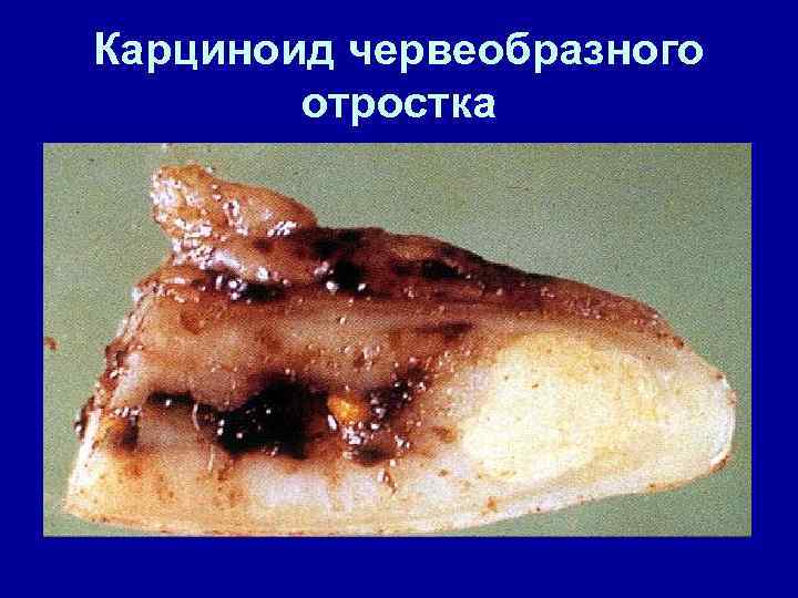 Карциноид червеобразного отростка 