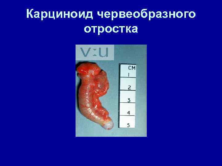 Карциноид червеобразного отростка 