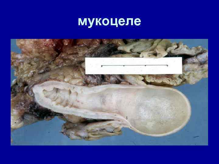 мукоцеле 