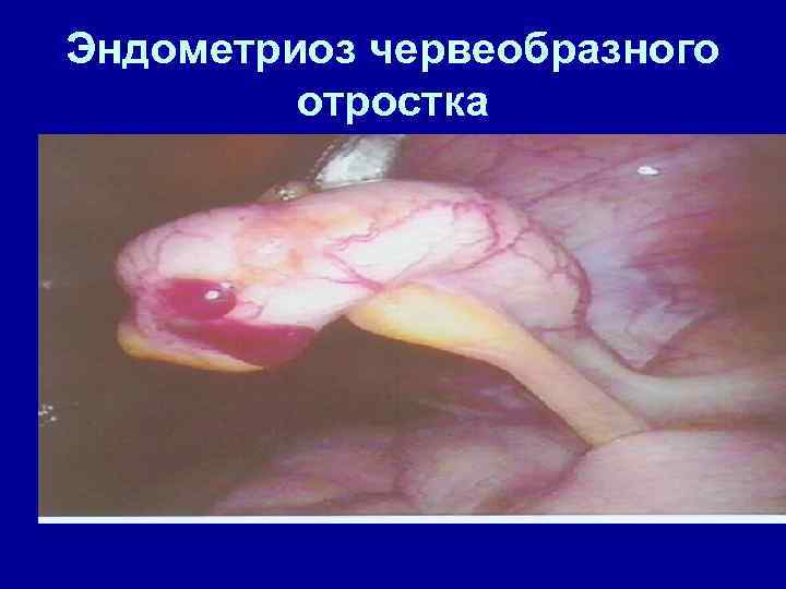 Эндометриоз червеобразного отростка 