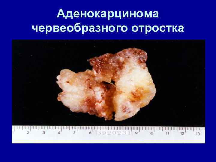 Аденокарцинома червеобразного отростка 