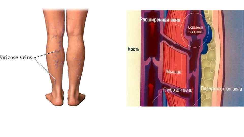 Варикозное расширение вен 