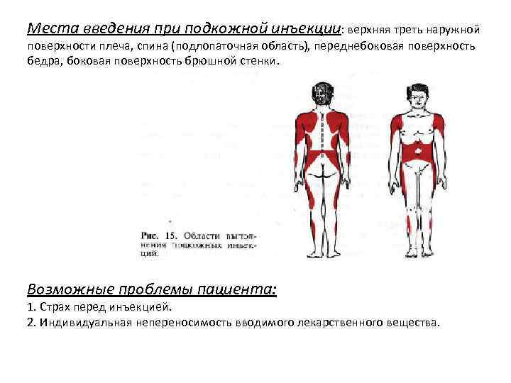 Места введения при подкожной инъекции: верхняя треть наружной поверхности плеча, спина (подлопаточная область), переднебоковая