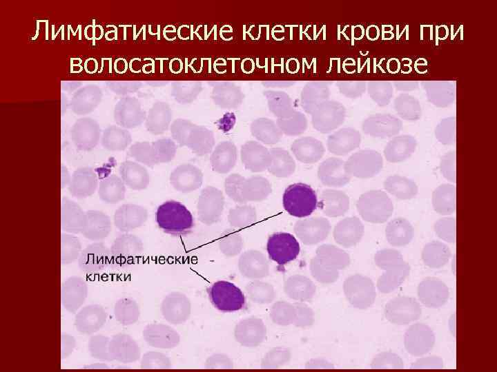 Лимфатические клетки крови при волосатоклеточном лейкозе 