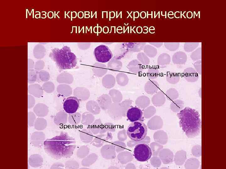 Мазок крови при хроническом лимфолейкозе 