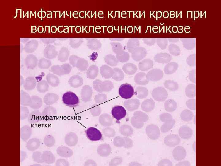 Лимфатические клетки крови при волосатоклеточном лейкозе 