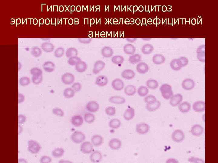 Гипохромия и микроцитоз эритороцитов при железодефицитной анемии 