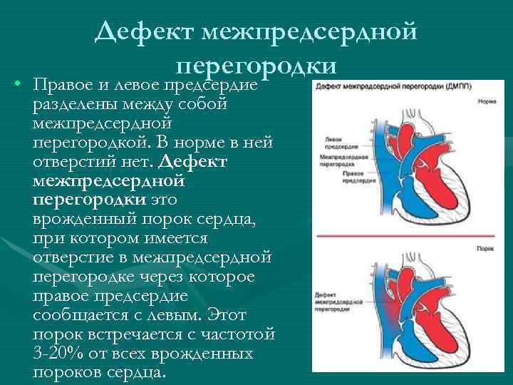 Дефект межпредсердной перегородки • Правое и левое предсердие разделены между собой межпредсердной перегородкой. В