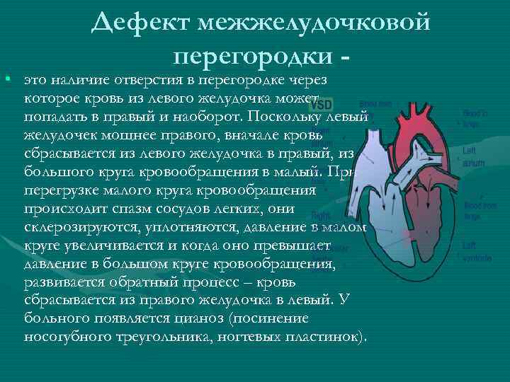 Дефект межжелудочковой перегородки - • это наличие отверстия в перегородке через которое кровь из