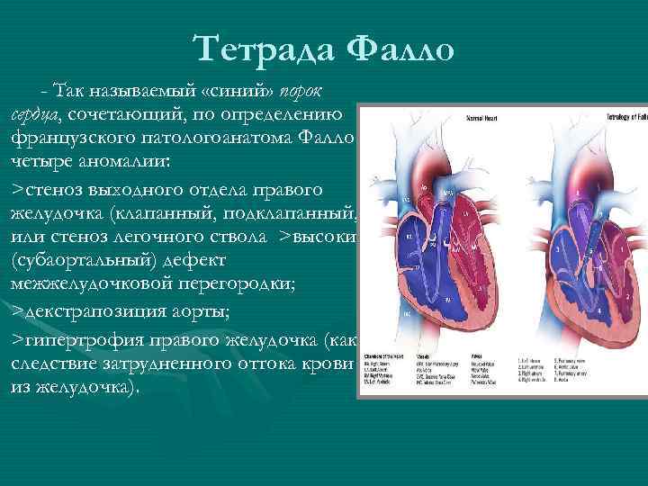 Тетрада Фалло - Так называемый «синий» порок сердца, сочетающий, по определению французского патологоанатома Фалло