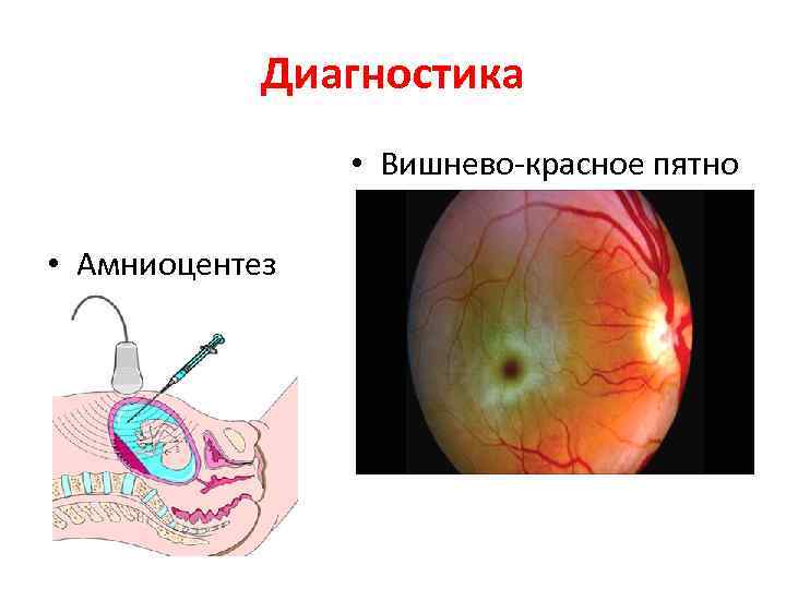 Болезнь тея сакса картинки